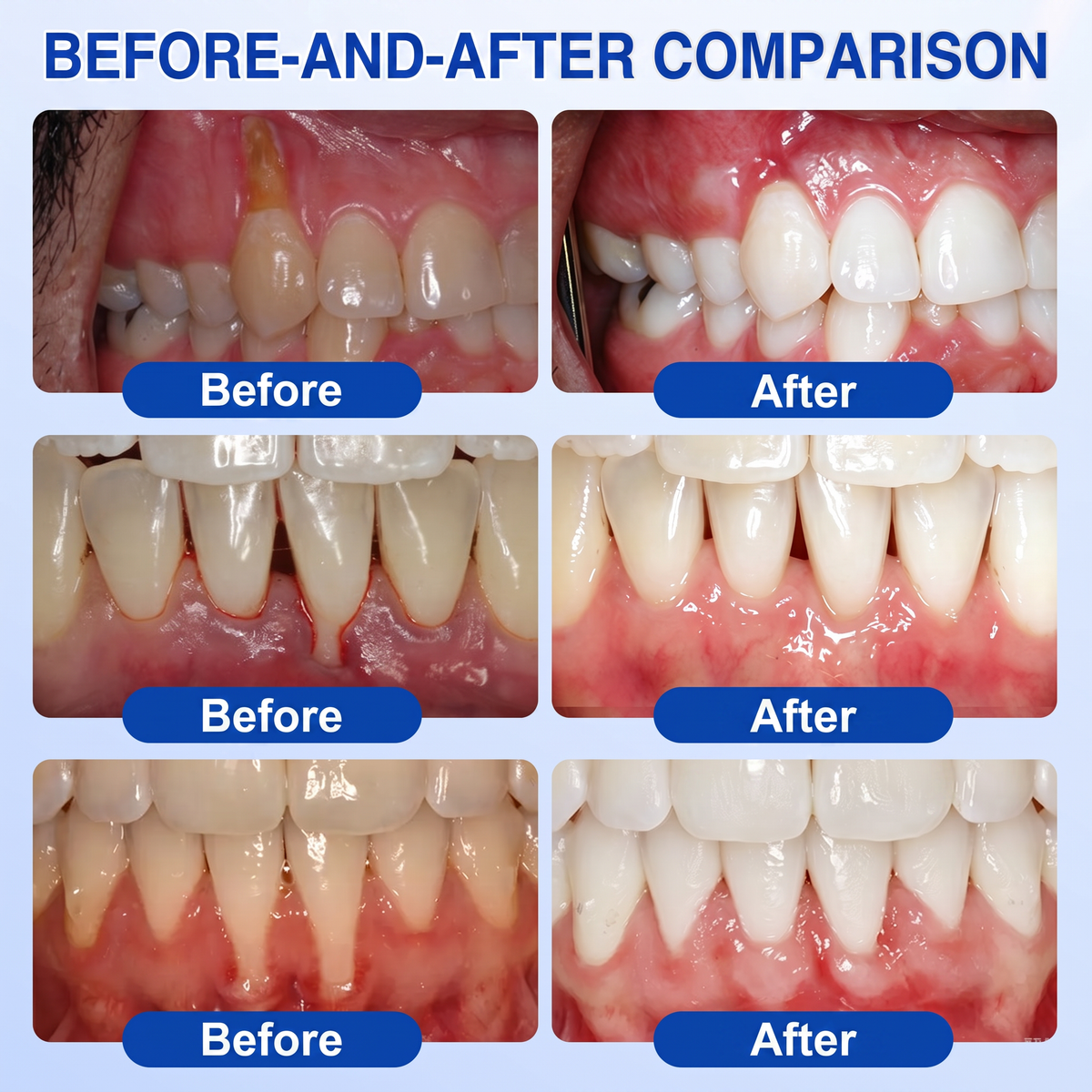 🇬🇧NATRAVOR® 🦷GumRevive periodontal repair gel🌲